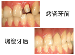 烤瓷牙有哪几种