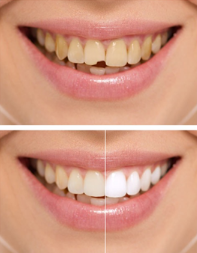 皓齿美白的效果为什么这么好呢