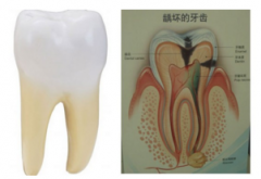 儿童龋齿影响口腔健康