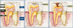 龋齿为何越早补越好