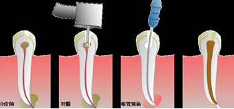 什么情况下采取根管治疗