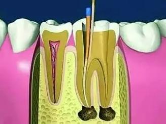 根管治牙是一项“救牙工程”
