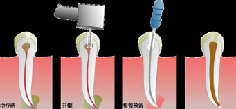 根管治疗概述