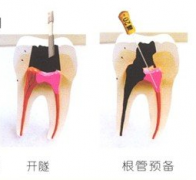 根管治疗容易陷入误区