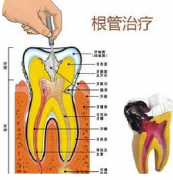 根管治疗为什么那么贵