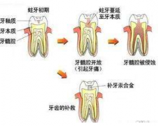 宝宝的龋齿如何治疗